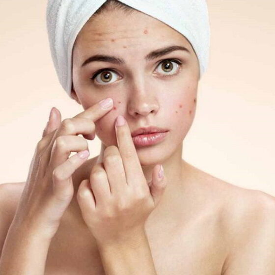 How to cover pitted acne scars with makeup